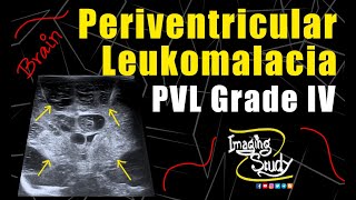 Periventricular Leukomalacia Grade IV  Ultrasound  Case 146 [upl. by Migeon]