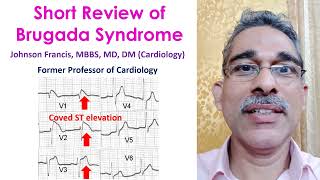 Short Review of Brugada Syndrome [upl. by Davine]