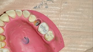 Amalgam restoration for maxillary first molar [upl. by Nerral]