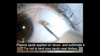 Conjunctival Nevus by PLEXR Plasma [upl. by Hootman]