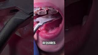 Removing a Fixed Bite Plate  Removing Fixed Orthodontic appliance  Toothtime Family Dentistry NBTX [upl. by Beilul329]