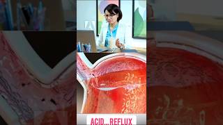 Acid reflux disease 😭😭😭😭doctor [upl. by Nicolina]