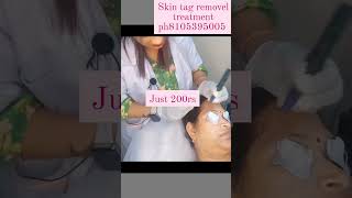 skin tag removel treatment [upl. by Olenta911]