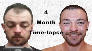 Hair Transplant Timelapse 04 months [upl. by Ydnis587]