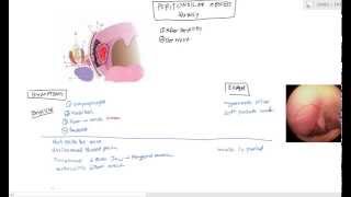 Peritonsillar Abscess Quinsy for USMLE Step 2 [upl. by Nosa461]