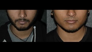 Jaw Implants Mandibular Gonial Angle Before and After NYC jawimplantsformen jawaugmentation [upl. by Bobbette]