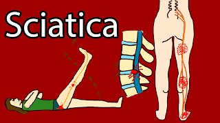 Sciatica  Onesided Leg pain and tingling Sciatica Symptoms and Treatment Radiculopathy [upl. by Seitz]