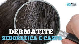 DERMATITE SEBORREICA E CASPA QUAIS SÃO AS CAUSAS E O QUE FAZER [upl. by Ettegdirb]