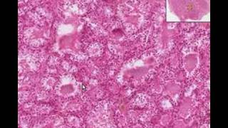 Histopathology ThyroidGraves Disease [upl. by Ardnossak]