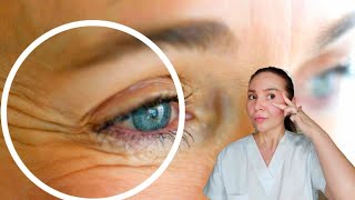 How to reduce under eye wrinkles  Wrinkles around the eyes Crowsfeet [upl. by Cardwell]