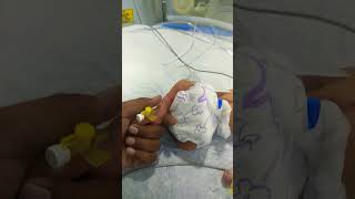 How to insert cannula in newborn baby ventilator newborncare criticalbaby [upl. by Cuttler]