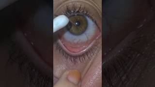 eye mucus string removal [upl. by Elbag]