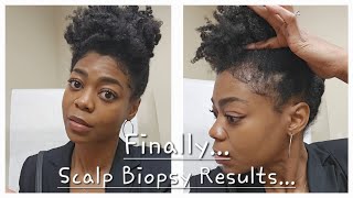 Scalp Biopsy Results Treatment Options amp Venting  4C Natural Hair  Hair Loss [upl. by Nerrak]