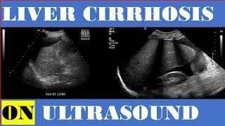 liver Cirrhosis on Ultrasound [upl. by Leona]