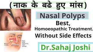 Homoeopathic Medicine For Nasal Polypsनाक के बढे हुए मांस [upl. by Klute830]