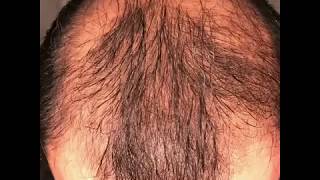 1 year using minoxidil  Rogaine 5 Before amp After results [upl. by Dean530]