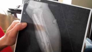 Suzanne shares her Xrays after Snowmobile Accident [upl. by Eema206]