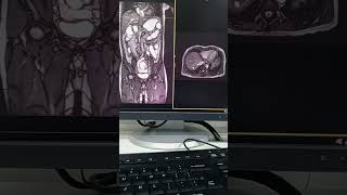 Mri enterography first time nakagawa nito [upl. by Laiceps683]