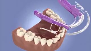 How Does Inman aligner braces work to straighten up teeth [upl. by Aiam]