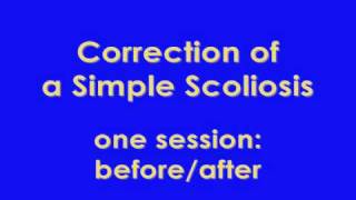 Scoliosis correction by Hanna Somatic Education  see description [upl. by Nappy]