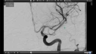 How Endovascular Stroke Treatment Works [upl. by Pufahl919]