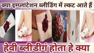 Kya Implantation bleeding me clots aate hai।Heavy Bleeding hoti hai।Implantation Bleeding Vs Periods [upl. by Willabella873]