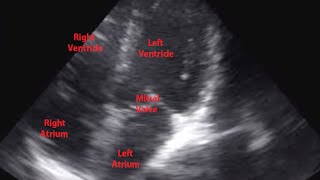 Echocardiogram of Premature Ventricular Contraction  Loop [upl. by Lennard]