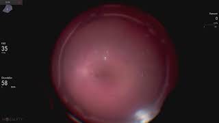 Retinal detachment repair Lukan Mishev live stream [upl. by Will]