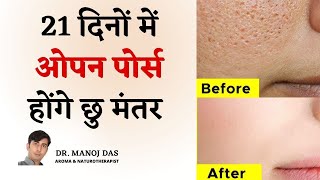 21 दिनों में खत्म Clogged Pores Blackheads Bumps Whiteheads and Large Pores I DR MANOJ DAS [upl. by Ashli]