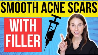 Filler For Acne Scars  Dermatologist Explains [upl. by Regor]