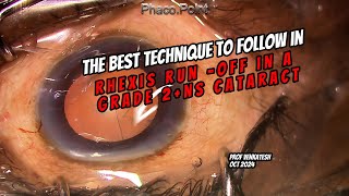 The Best Technique to follow in Rhexis RunOff during CCC in a grade 2NS cataract [upl. by Yralih]