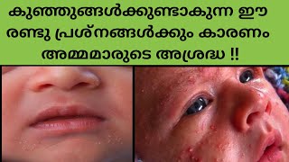 Causes And Home Remedies To Treat Baby Acne And Miliaകുഞ്ഞുങ്ങൾക്കുണ്ടാകുന്ന skin problems [upl. by Nyra879]