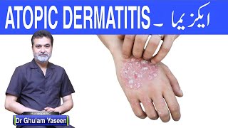 ECZEMA CAUSES SYMPTOMS TREATMENT ایکزیما علامات وجوھات علاج [upl. by Radec]