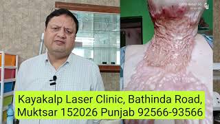 Best Laser Treatment for Burn Scars  Laser Combination Treatment  Double Engine Treatment Recovery [upl. by Priebe747]