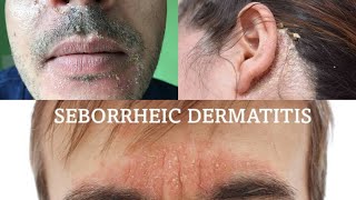 Seborrheic dermatitis  treatment health [upl. by Grenville]