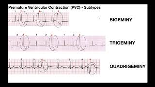 EKG Patterns  Premature Atrial amp Ventricular Contractions PACs amp PVCs [upl. by Elly]