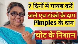 चोट के निशान कैसे मिटाये  Pimples ke daag kaise hataye  Tanke ke nishan kaise mitaye [upl. by Aholah633]