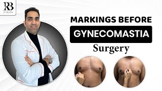 Markings before Gynecomastia surgery  Dr Ritesh Bazaz gynecomastiatreatment [upl. by Enicul]