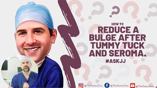 How to reduce a bulge after tummy tuck and seroma [upl. by Haneeja34]