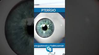 CATARATA VS PTERÍGIO saúdeocular oftalmologista [upl. by Plafker592]