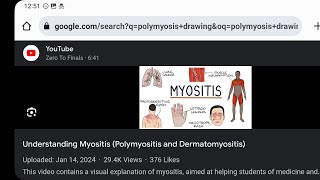 Mystery diagnosis polymyositis [upl. by Landa]