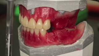 What is OM DENTURE SYSTEM [upl. by Graaf]