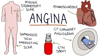 Understanding Angina Visual Explanation for Students [upl. by Ahsikram]