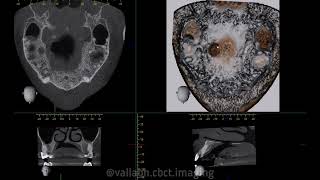 SURGICAL DEFECT as seen in a CBCT scan [upl. by Jaella]