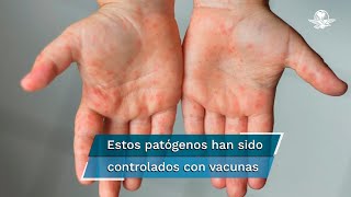 ¿Por qué están comparando a la variante ómicron del coronavirus con el sarampión [upl. by Lledniuq]