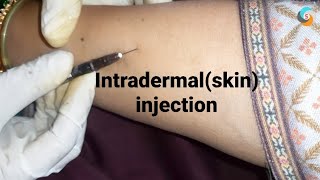 intradermal or skin injection [upl. by Peggi]