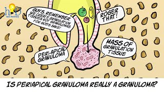 What is periapical granuloma [upl. by Yralam714]