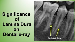 Alveolar bone anatomy Lamina Dura Radiographic Features and Clinical Importance [upl. by Pomfrey879]