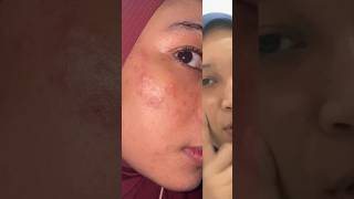 Dermatitis Perioral My experience 20232024 skincare dermatitis skimcarelokal [upl. by Quitt770]