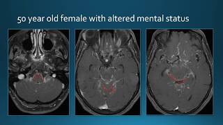 Meningeal Enhancement [upl. by Wilmer135]